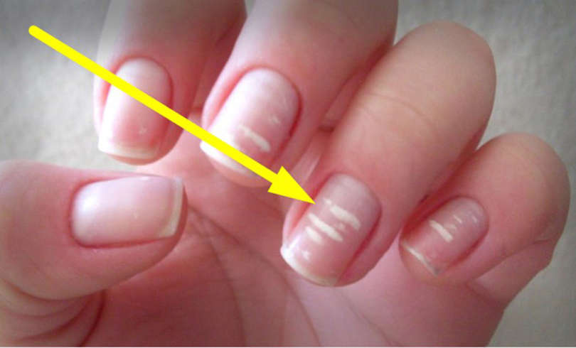 Las manchas blancas de las uñas, ¿por qué aparecen?