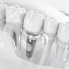 Implantes dentales corticales