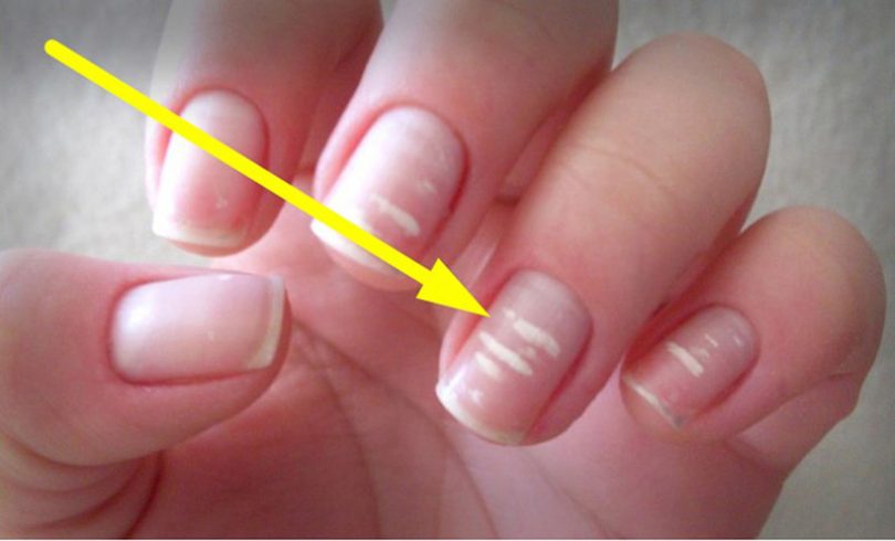Las manchas blancas en las uñas, ¿por qué aparecen?
