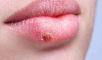 Cómo curar los fuegos en los labios (herpes)