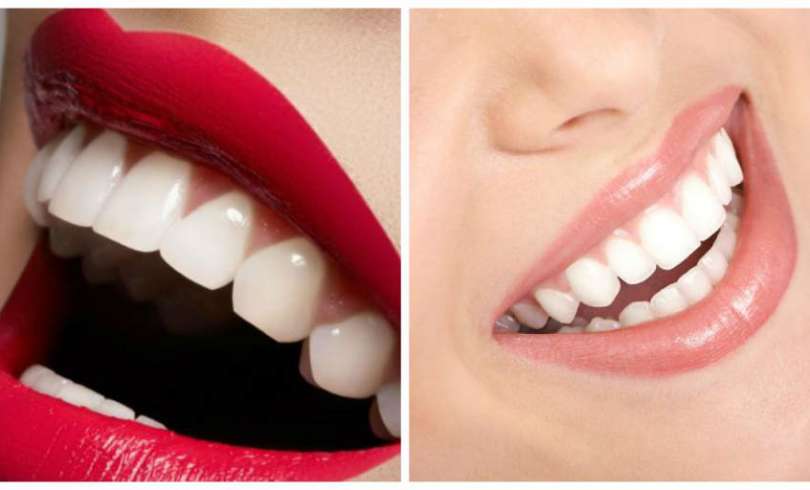 El método mas efectivo para blanquear tus dientes en casa